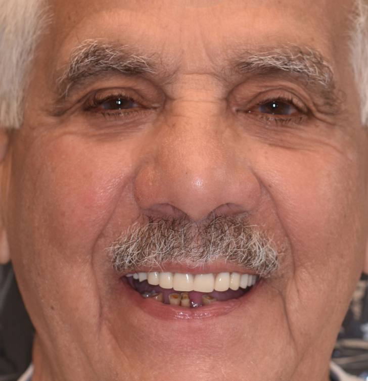 Before photo of discolored, misaligned teeth