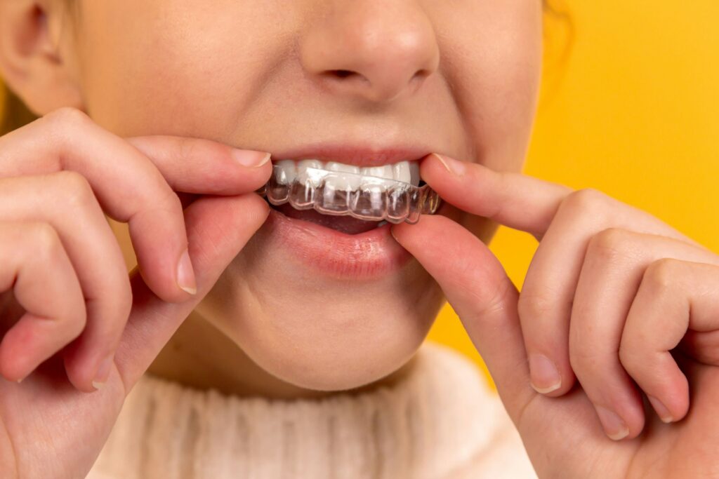 Invisalign for adults